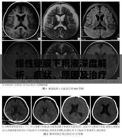 慢性硬膜下积液深度解析，症状、原因及治疗方法